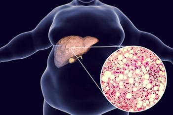 fatty liver disease illustration